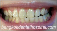 dental makeover : BriteSmile teeth whitening