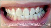 dental makeover : BriteSmile teeth whitening