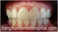 dental makeover : BriteSmile teeth whitening