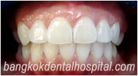 dental makeover : BriteSmile teeth whitening