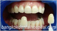 dental makeover : BriteSmile teeth whitening