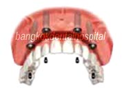 all-on-4 implant for edentulous jaw