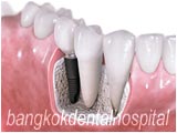 Astra Tech OsseoSpeed Implant with bone loss, perio-implant