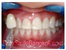 after BriteSmile Treatment