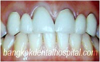 before dental extreme makeover : dental bridges