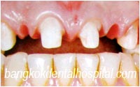 dental extreme makeover : dental bridges