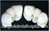 dental extreme makeover : dental bridges