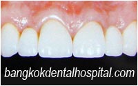 after dental extreme makeover : dental bridges