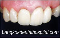 before dental extreme makeover : dental bridges