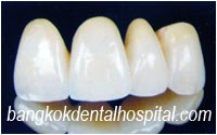 dental extreme makeover : dental bridges