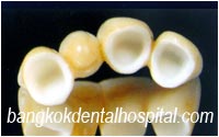 dental extreme makeover : dental bridges