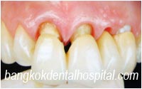 dental extreme makeover : dental bridges