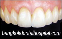 after dental extreme makeover : dental bridges