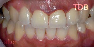 upper dental crown