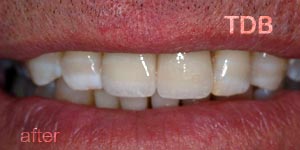 upper dental crown