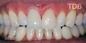 upper dental crown