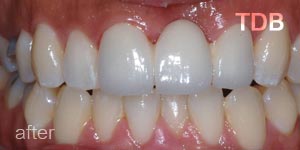 upper dental crown