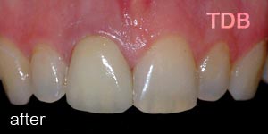 upper dental crown