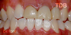 upper dental crown