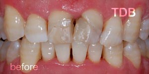 upper dental crown