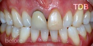 upper dental crown