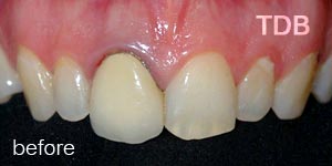 upper dental crown