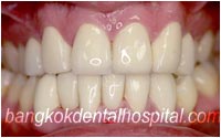 dental makeover : dental crowns