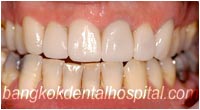 dental makeover : dental crowns