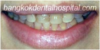 porcelain veneers, dental veneers dental clinic in bangkok thailand