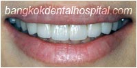 porcelain veneers, dental veneers dental clinic in bangkok thailand