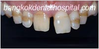 porcelain veneers, dental veneers dental clinic in bangkok thailand