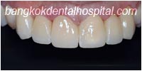 porcelain veneers, dental veneers dental clinic in bangkok thailand