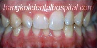 porcelain veneers, dental veneers dental clinic in bangkok thailand