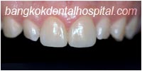 porcelain veneers, dental veneers dental clinic in bangkok thailand