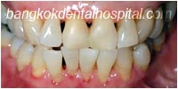 porcelain veneers, dental veneers dental clinic in bangkok thailand