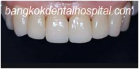 porcelain veneers, dental veneers dental clinic in bangkok thailand