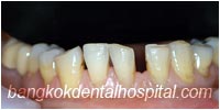 porcelain veneers, dental veneers dental clinic in bangkok thailand