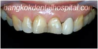 porcelain veneers, dental veneers dental clinic in bangkok thailand