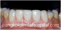 porcelain veneers, dental veneers dental clinic in bangkok thailand