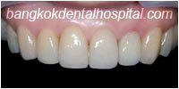 porcelain veneers, dental veneers dental clinic in bangkok thailand