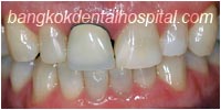 porcelain veneers, dental veneers dental clinic in bangkok thailand