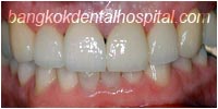 porcelain veneers, dental veneers dental clinic in bangkok thailand