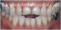 porcelain veneers, dental veneers dental clinic in bangkok thailand