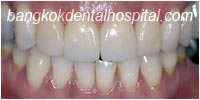 porcelain veneers, dental veneers dental clinic in bangkok thailand