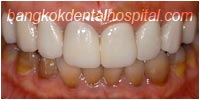 porcelain veneers, dental veneers dental clinic in bangkok thailand