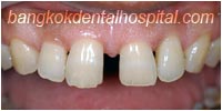 porcelain veneers, dental veneers dental clinic in bangkok thailand