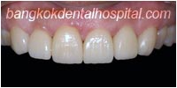 porcelain veneers, dental veneers dental clinic in bangkok thailand