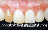 dental makeover : dental veneers