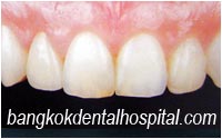 dental makeover : dental veneers