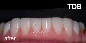 dental porcelain veneers